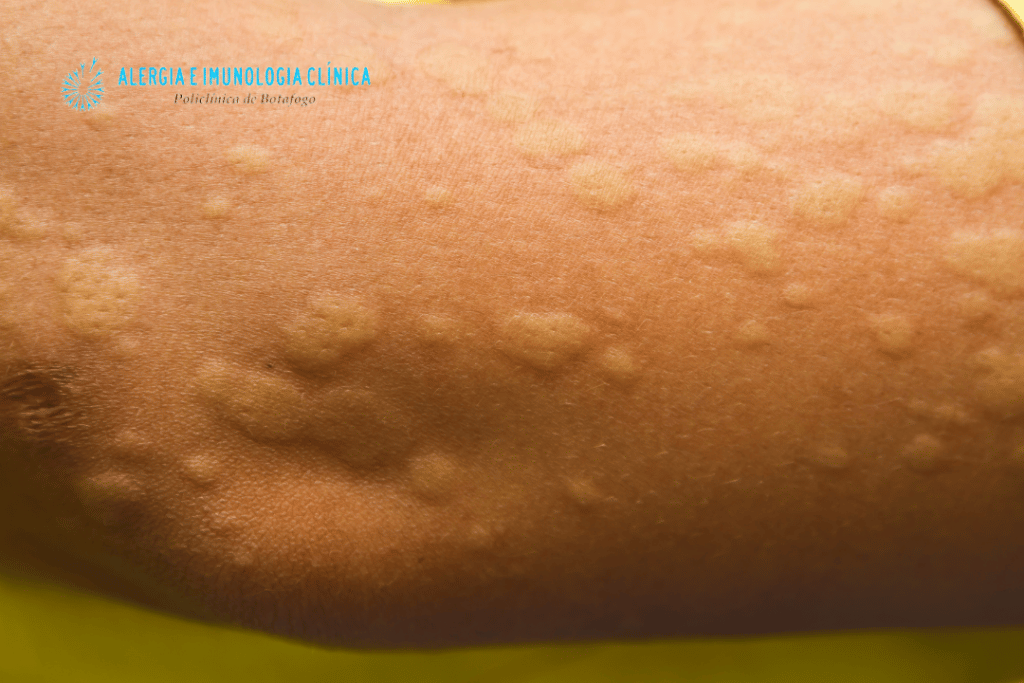 urticaria cronica