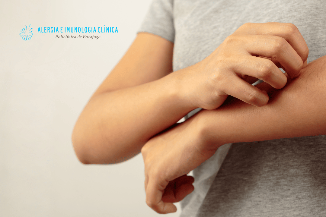 Alergia a dipirona e anti-inflamatórios – Alergia Botafogo – Alergistas ...