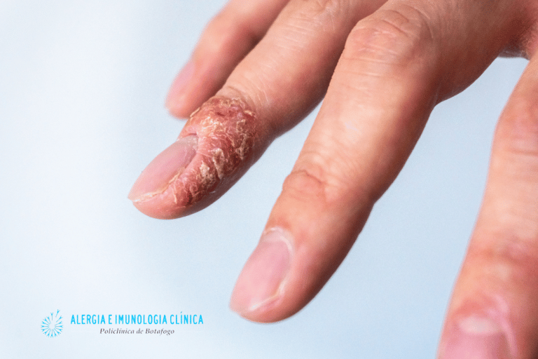 Alergia a esmalte de unha. - Alergia Botafogo - Alergistas Rio de Janeiro