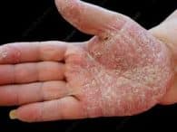 dermatite de contato em mãos