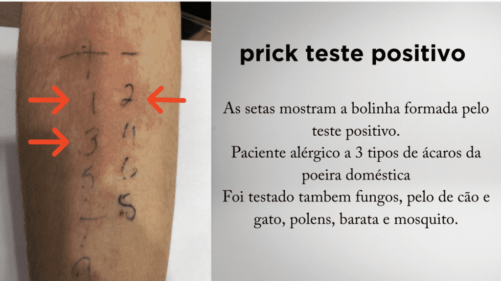 Prick teste Positivo