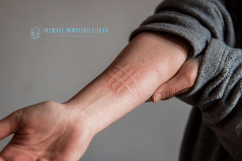 Dermografismo Do Diagn stico Ao Tratamento Alergia Botafogo Dermografismo Do Diagn stico Ao Tratamento Alergia Botafogo