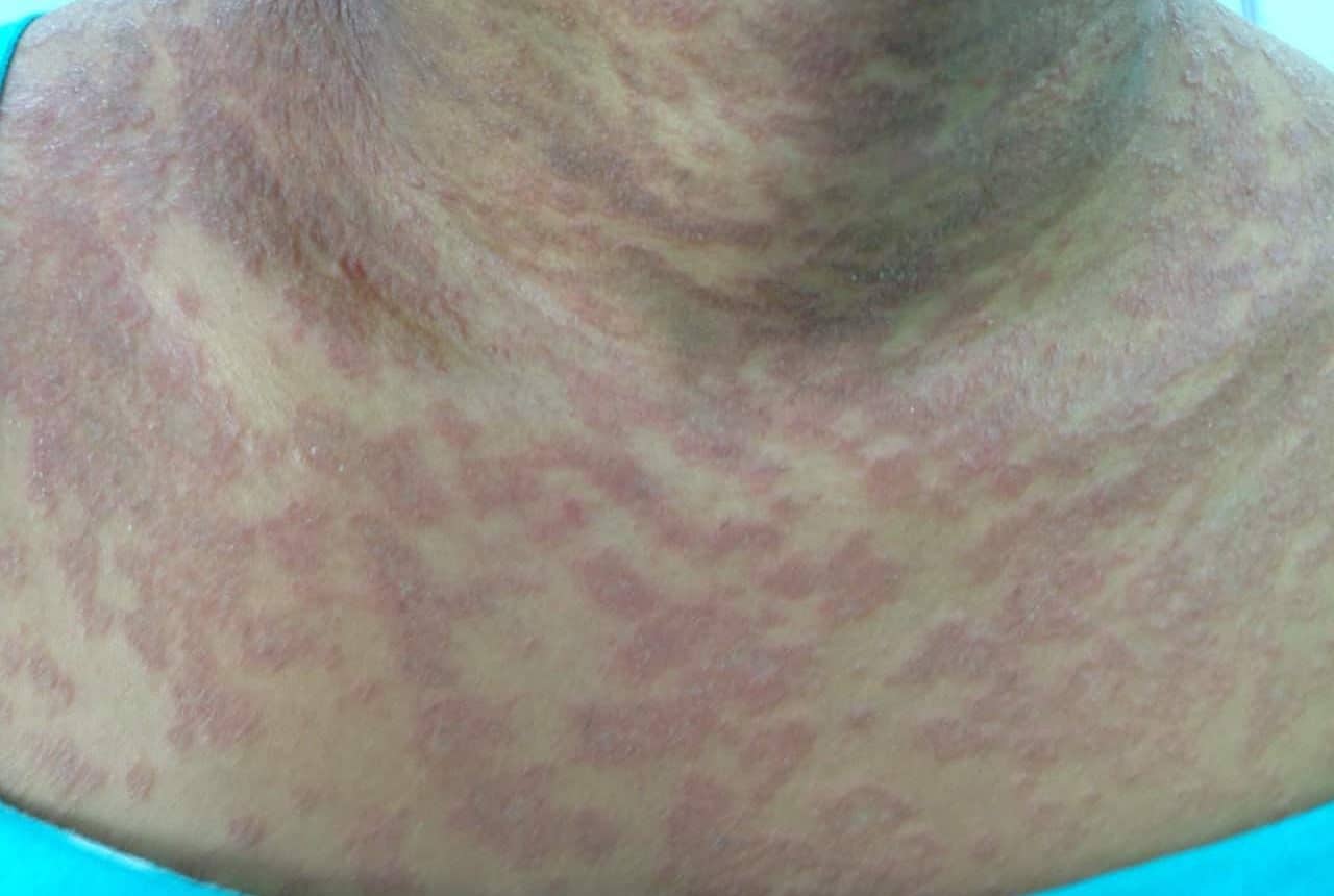 6 tipos de alergia na pele, causas e tratamento. – Alergia Botafogo ...