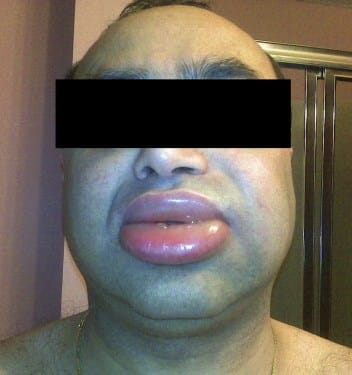 angioedema