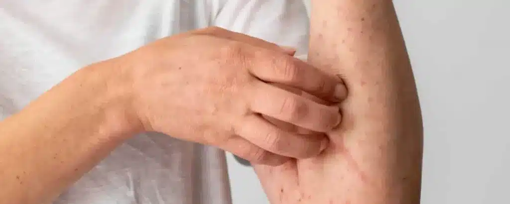 alergia na pele