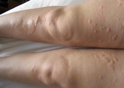 urticaria na pele