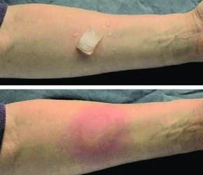 urticaria teste cubo de gelo