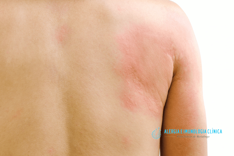 6 tipos de alergia na pele, causas e tratamento. - Alergia Botafogo