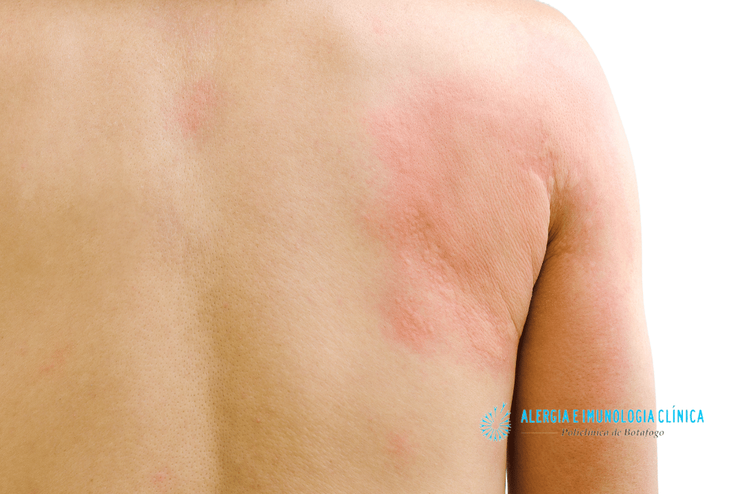 6 tipos de alergia na pele, causas e tratamento. - Alergia Botafogo