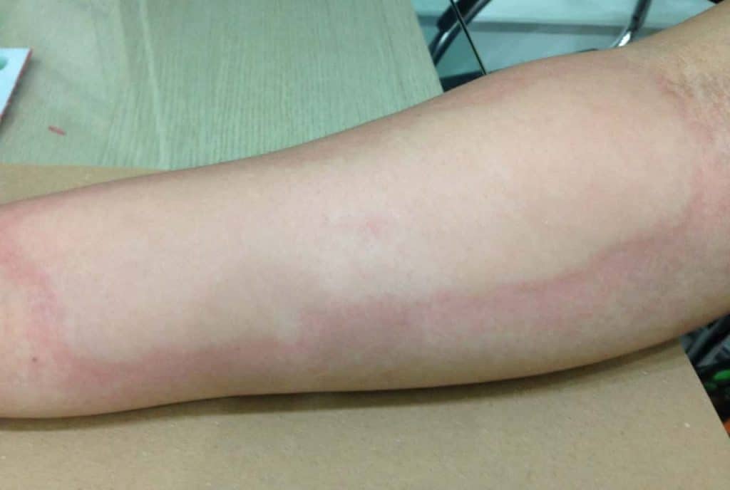 urticaria alergia ao frio