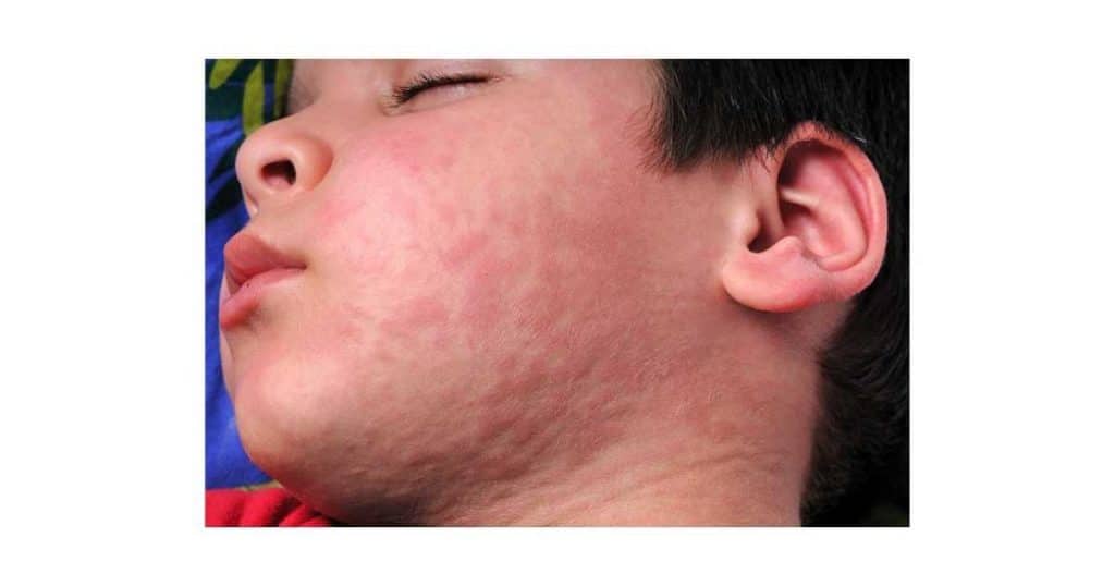 urticaria por alergia a amoxicilina