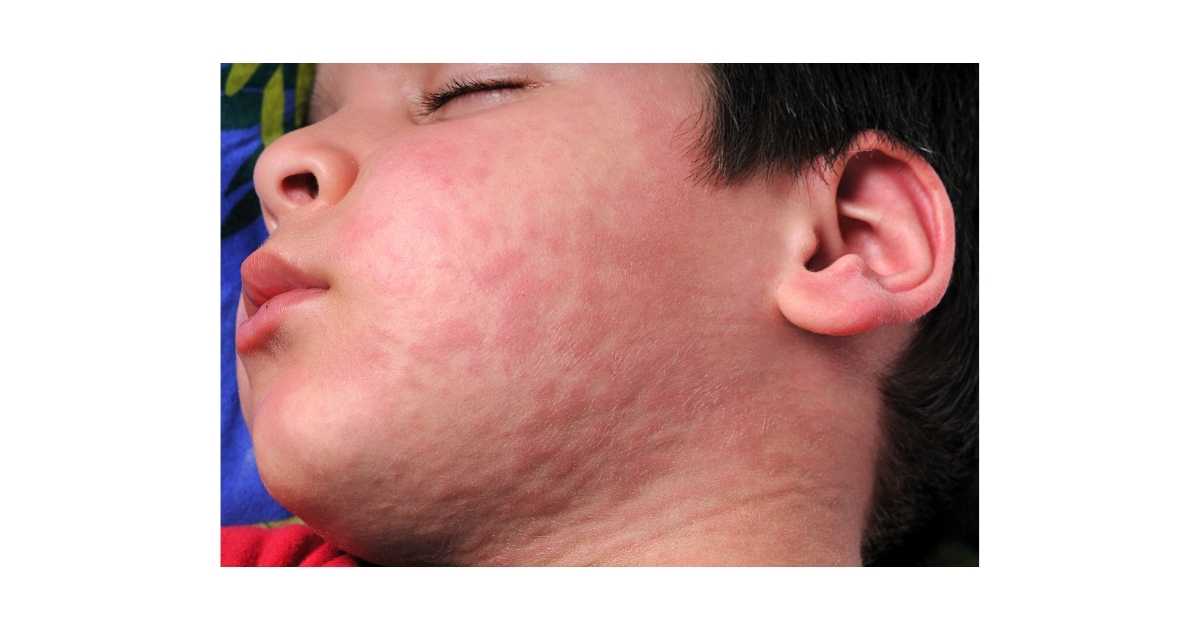 Alergia A Amoxicilina E Penicilina Alergia Botafogo Alergistas Rio alergia-a-amoxicilina-e-penicilina-alergia-botafogo-alergistas-rio